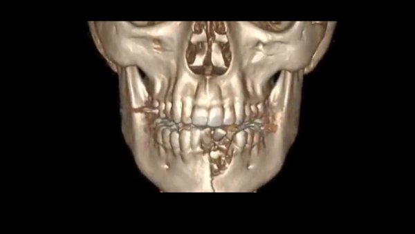The reconstructed computed tomography of Austin Burton's jaw following the March 26, 2018 event in which his VGOD vaporizer overheated and exploded.  - Sputnik International