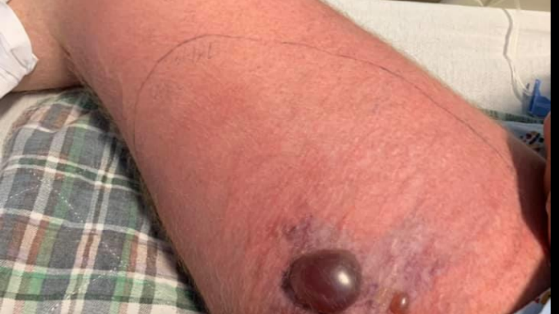 US Man Contracts Deadly Flesh-Eating Bacteria While Kayaking US Man Contracts Deadly Flesh-Eating Bacteria While Kayaking - Sputnik International, 1920, 02.09.2023