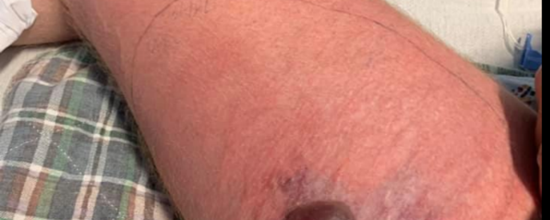 US Man Contracts Deadly Flesh-Eating Bacteria While Kayaking US Man Contracts Deadly Flesh-Eating Bacteria While Kayaking - Sputnik International, 1920, 02.09.2023