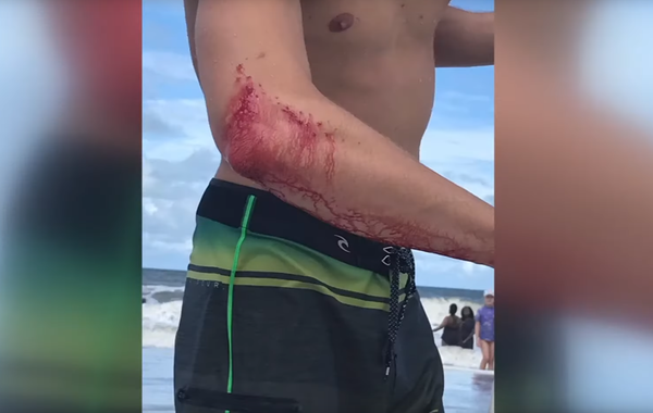 US Man Attacked by Shark Forgoes Hospital, Rushes Off to Local Bar (Photo) - Sputnik International