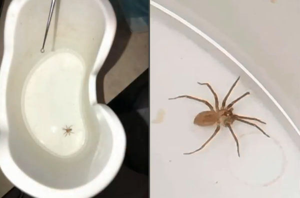 Venomous Brown Recluse Spider Discovered Inside US Woman’s Ear (Photo) - Sputnik International