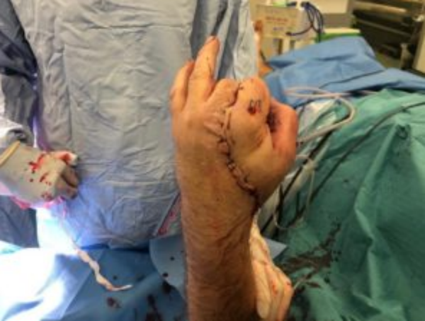 Graphic Photo: UK Man’s Hand Sliced by Electric Saw Reattached After Hours-Long Operation - Sputnik International