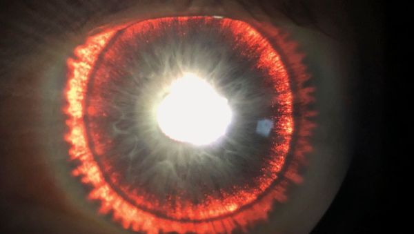 Case of Pigment Dispersion Syndrome (PDS) with Iris transillumination defects - Sputnik International