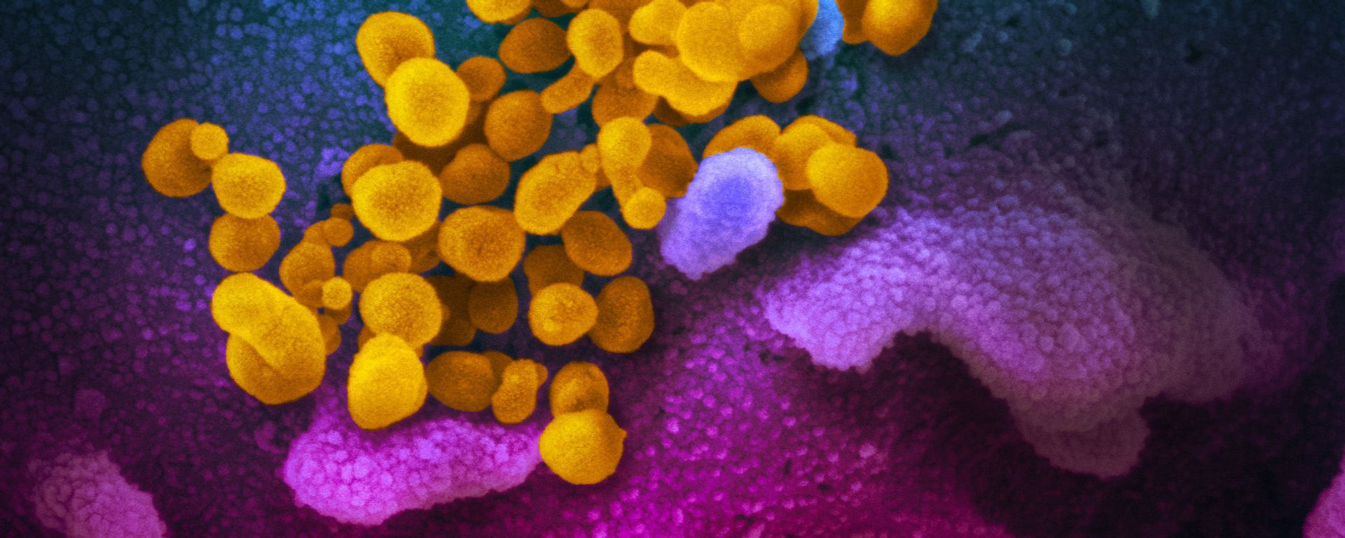 This scanning electron microscope image shows SARS-CoV-2 (yellow)—also known as 2019-nCoV, the virus that causes COVID-19—isolated from a patient in the U.S., emerging from the surface of cells (blue/pink) cultured in the lab. This scanning electron microscope image shows SARS-CoV-2 (yellow)—also known as 2019-nCoV, the virus that causes COVID-19—isolated from a patient in the U.S., emerging from the surface of cells (blue/pink) cultured in the lab. - Sputnik International, 1920, 22.06.2021
