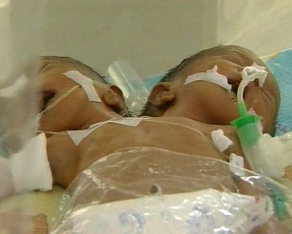 Conjoined twins - Sputnik International