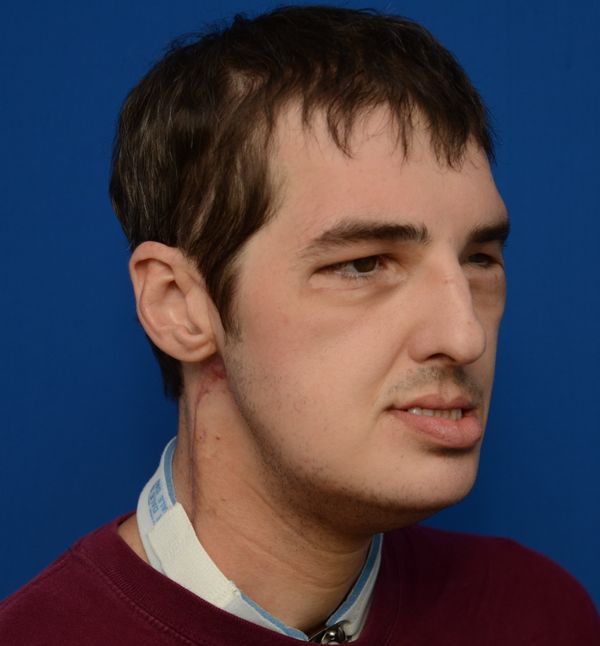 Richard Lee Norris seven months after his surgery. - Sputnik International