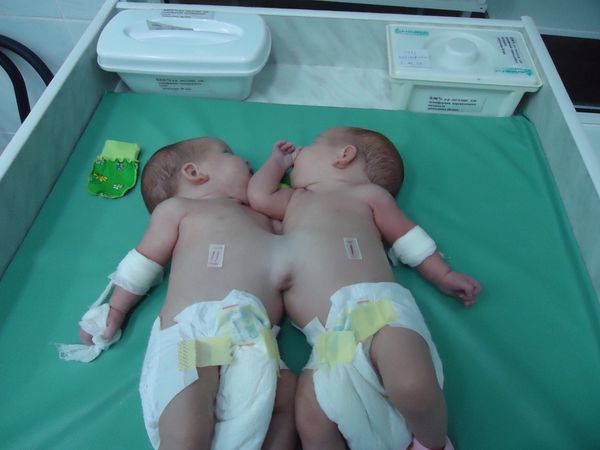 Siberian Doctors Separate Two-Month-Old Conjoined Twins - Sputnik International