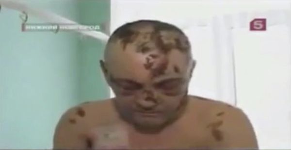 The effects of the flesh-eating drug 'krokodil,' or 'crocodile,' are seen on a patient in Russia. - Sputnik International