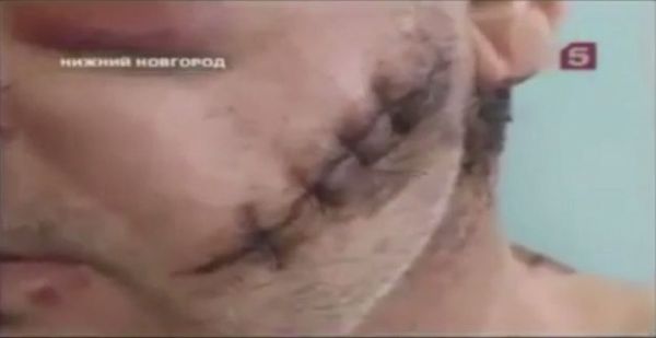 A close-up shot shows the man's disfigured face. Krokodil is used widely in Russia for its sedative effects. - Sputnik International