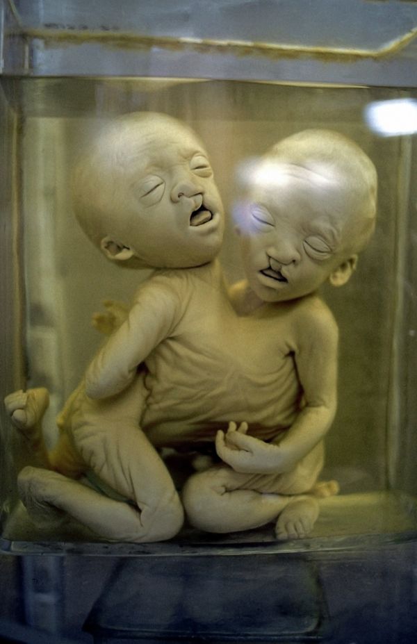 Woman Steals Conjoined Fetuses From Russian Museum – Police - Sputnik International