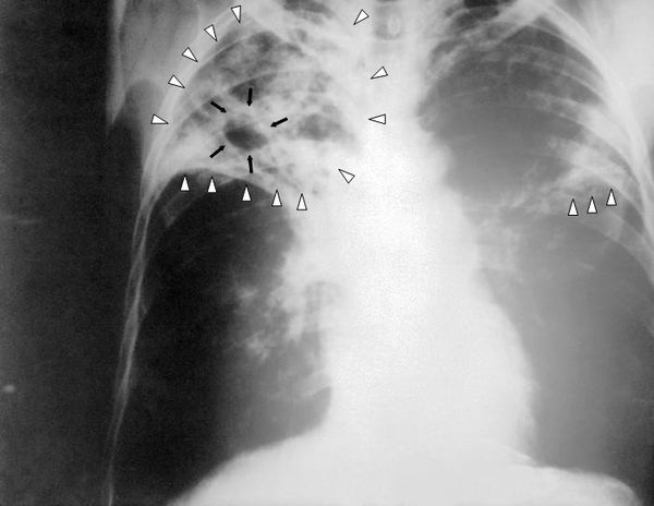In an op-ed for LiveScience.com, Treatment Action Group expert Colleen Daniels noted that the present model for tuberculosis research is significantly underfunded. - Sputnik International